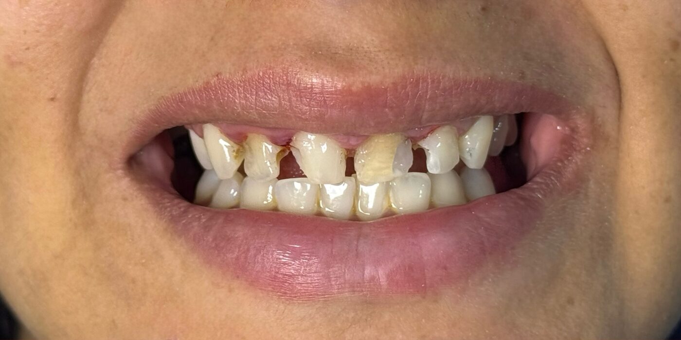 Sorriso antes das facetas em resina