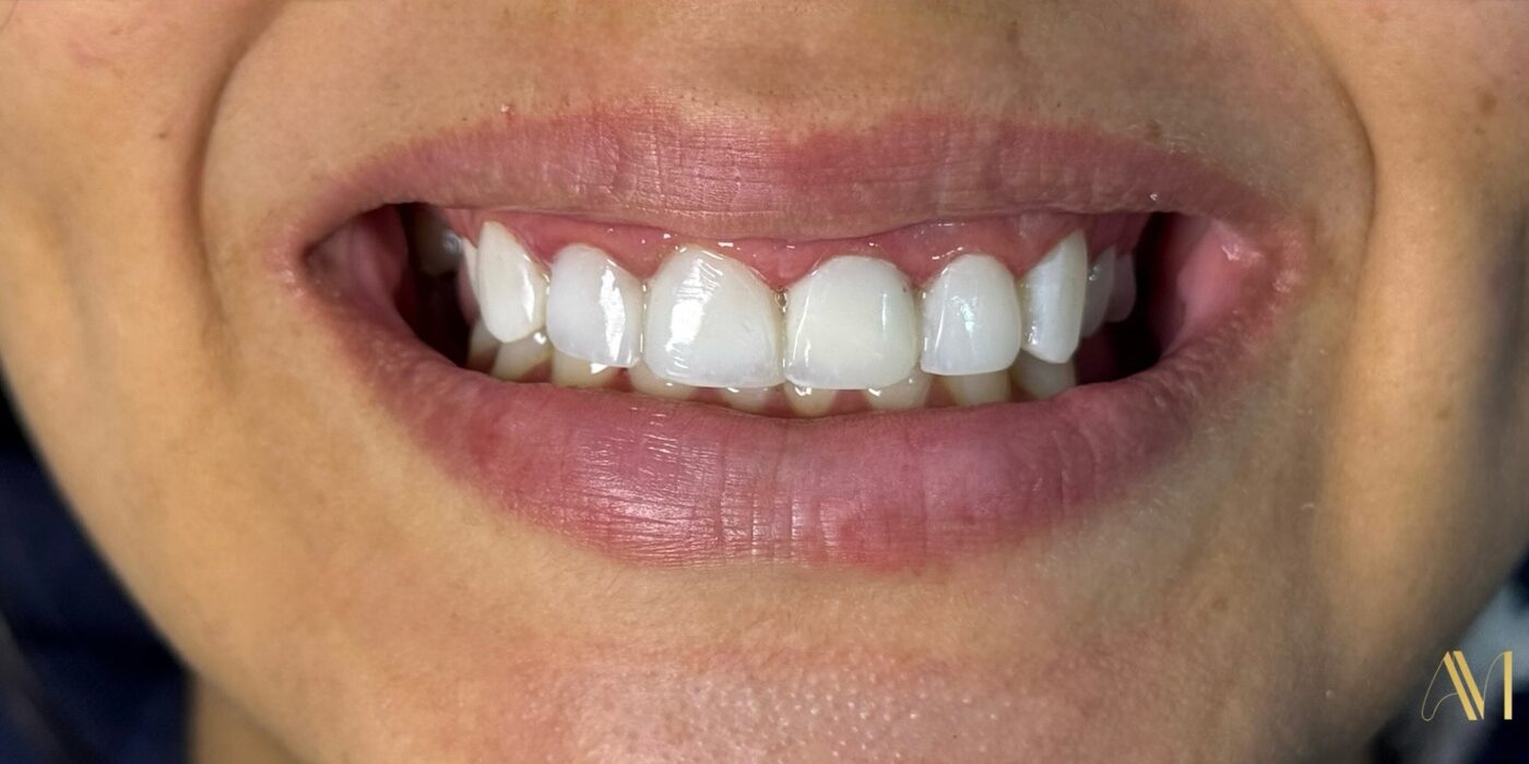 Sorriso depois das facetas em resina