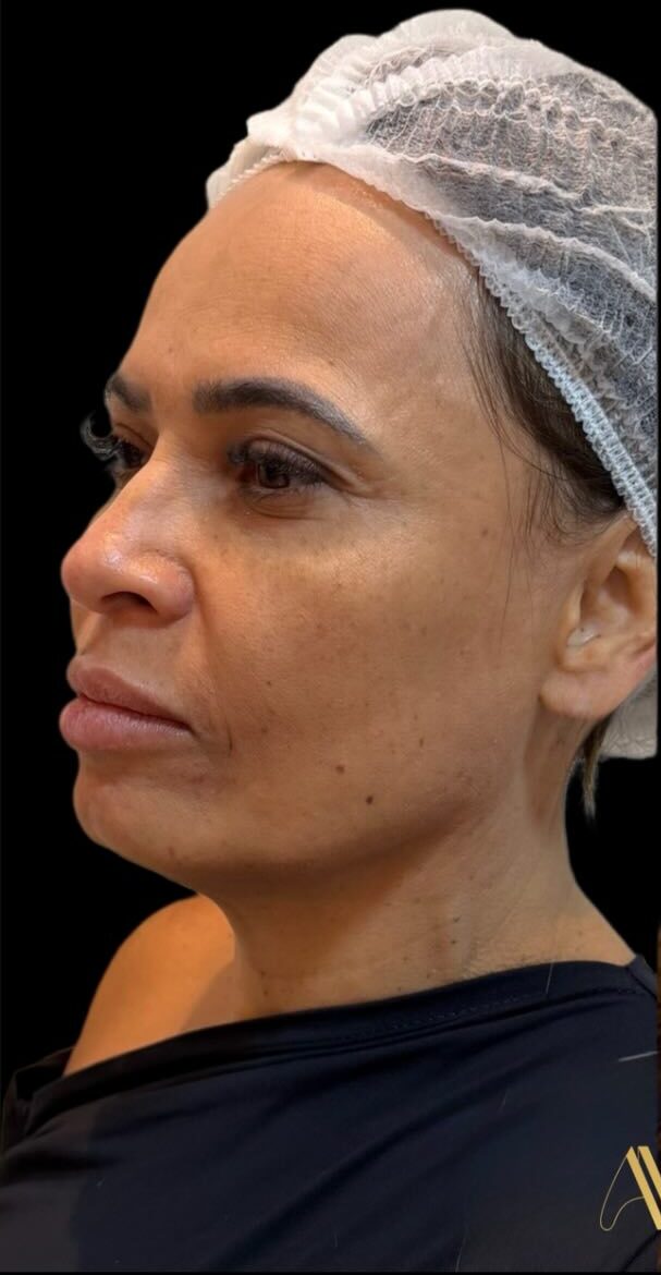 Rosto antes da harmonização full face