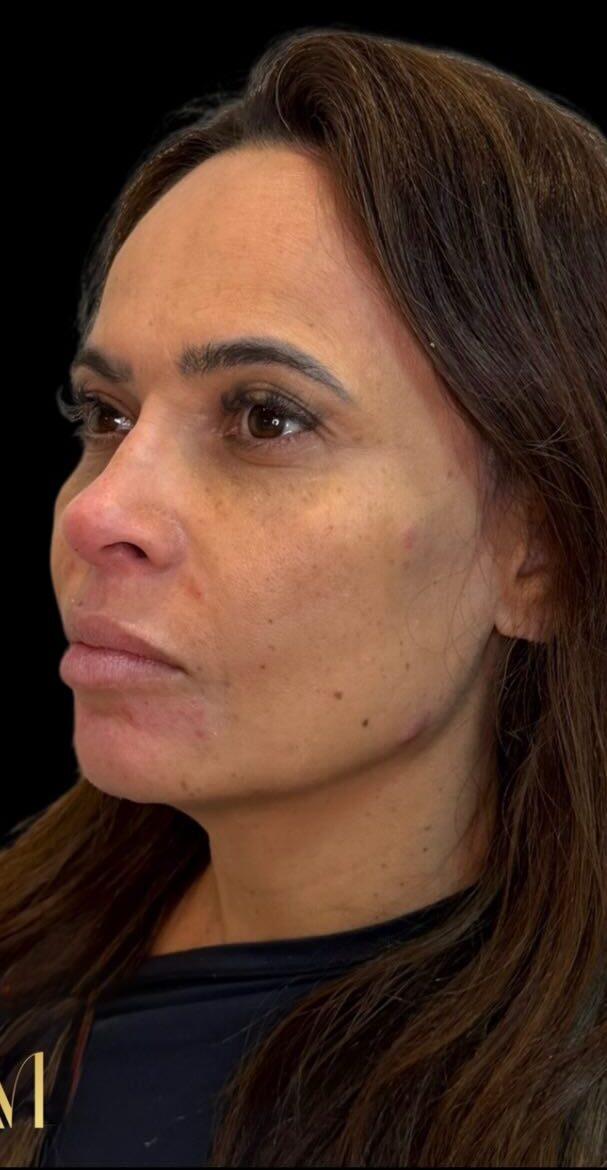 Rosto depois da harmonização full face